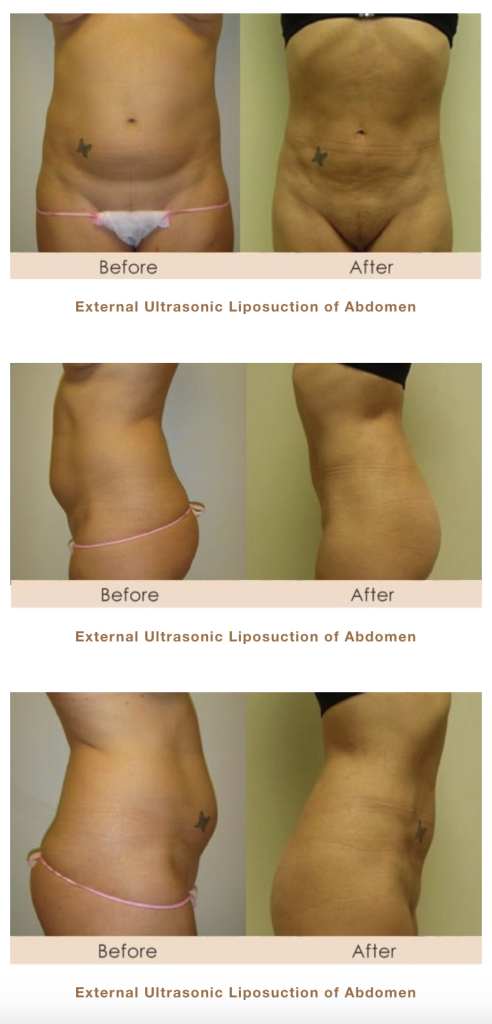 external ultrasonic liposuction of abdomen